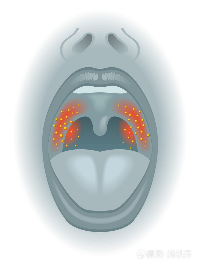 皮疹炎症形成的皮肤烧伤医学插图卡通女人有牙痛平式店面员工蓝制服