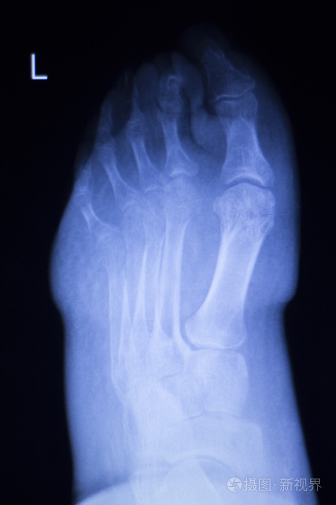 脚和脚趾损伤 x 射线扫描