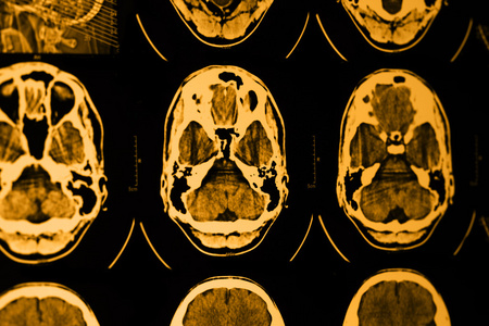 Ct 和 Mri 的头骨