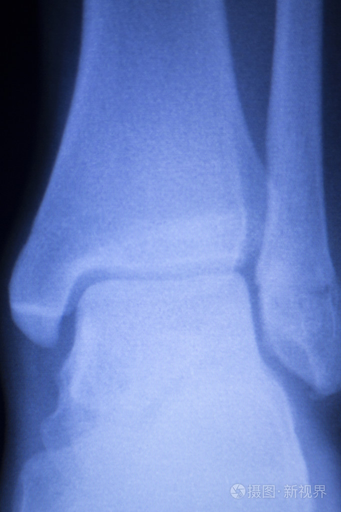 小腿踝关节损伤 x 线扫描
