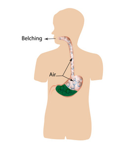 打嗝。在胃里的空气。食管和胃的结构。信息图表。矢量图