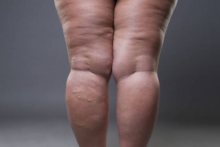 肥胖女性脂肪腿静脉曲张特写