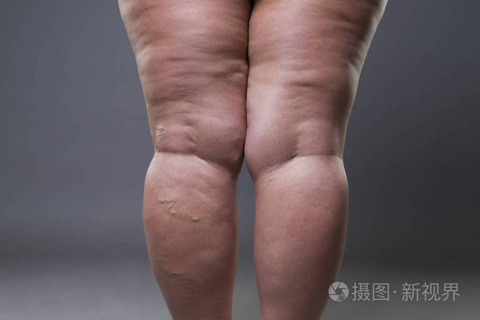 肥胖女性脂肪腿静脉曲张特写