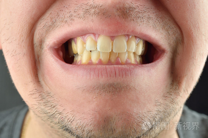 详细的形象的人露出的牙齿牙科保健服务霉素