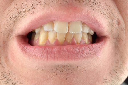 详细的形象的人露出的牙齿.牙科保健服务.霉素照片