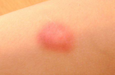 毛细血管破裂图片