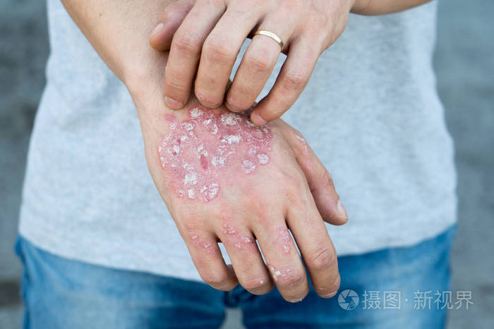 男人手上抓自己 片状皮肤干燥与寻常型银屑病 湿疹和其他皮肤状况如真菌 菌斑 皮疹和修补程序 遗传的自身免疫性疾病照片 正版商用图片0dz0fx 摄图新视界