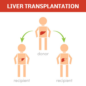 肝移植术的概念