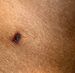 棕色的痕迹,从皮肤上的胎记照片