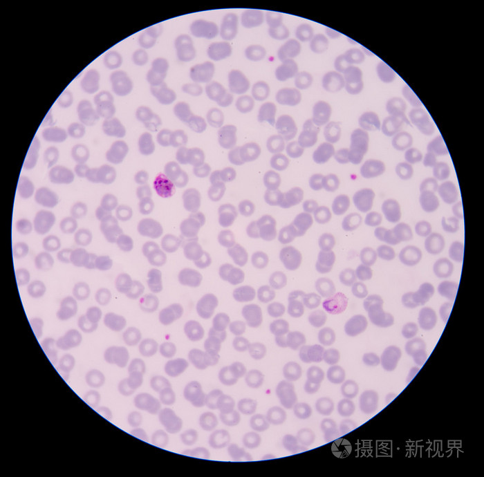 血液涂片薄膜疟疾寄生虫阳性
