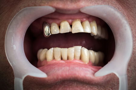 牙齿和牙龈的概念问题.中老年人的健康问题之一照片