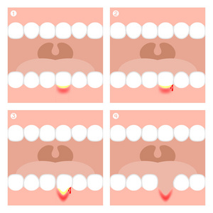患有牙龈炎或者牙周炎图矢量图