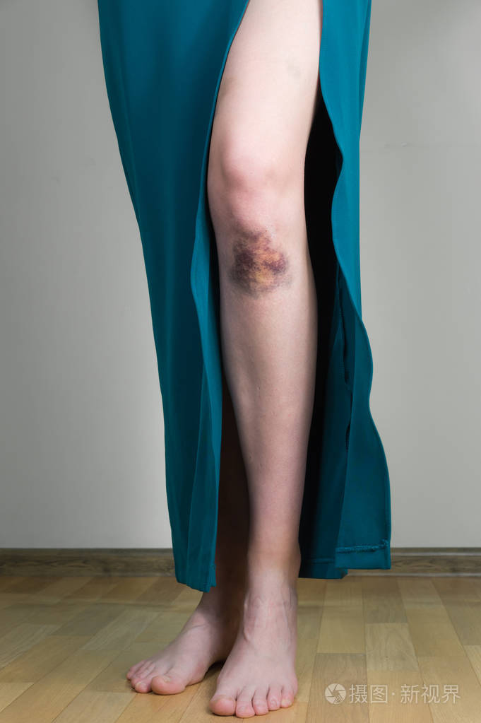 晚礼服与青肿的膝盖受伤的女人