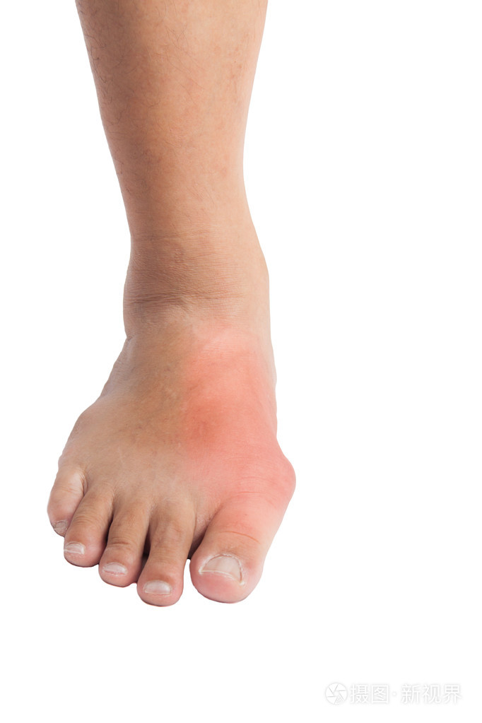 由痛苦痛风炎症引起的变形的大脚趾
