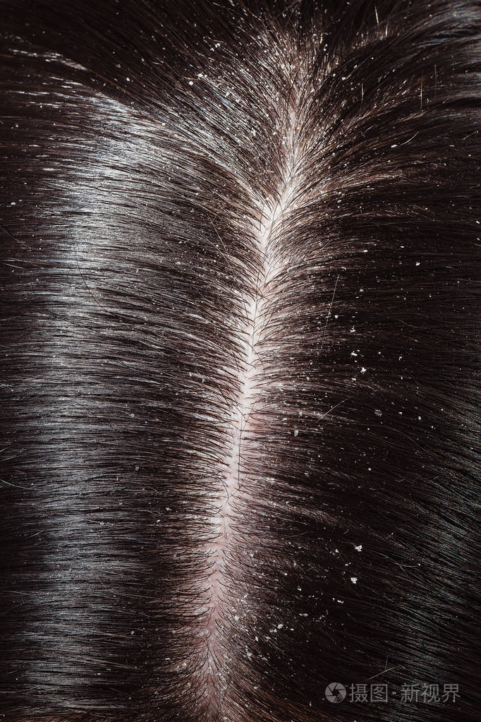 关于女人的黑头发头皮屑