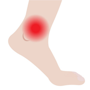 肿胀的脚和脚踝从感染或损伤