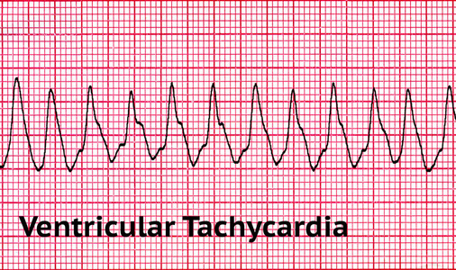 室性心动过速致命心脏节律