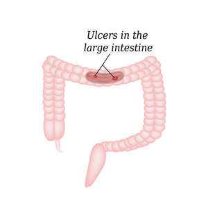 在肠道溃疡。在结肠溃疡。对孤立背景矢量图