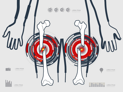矢量图的腿部骨折