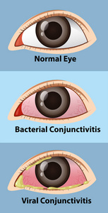 不同阶段的人眼结膜炎