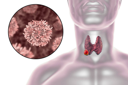 甲状腺癌插图