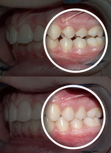 错牙合畸形正畸治疗前后图片