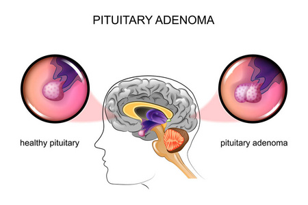 健康的垂体 垂体腺瘤