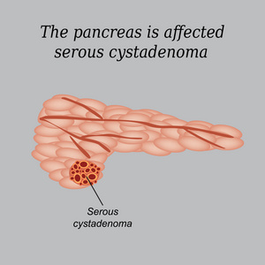 胰腺是受影响的浆液性囊腺瘤。在灰色的背景上的矢量图