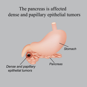 胰腺是受影响的密集和乳头状上皮性肿瘤。在灰色的背景上的矢量图