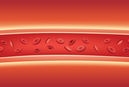 血管内栓塞治疗图片