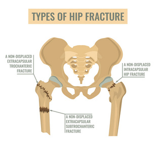 髋部骨折的类型
