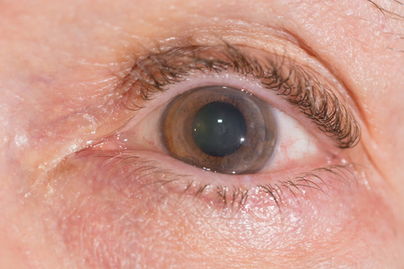 穿透性角膜移植在眼试验