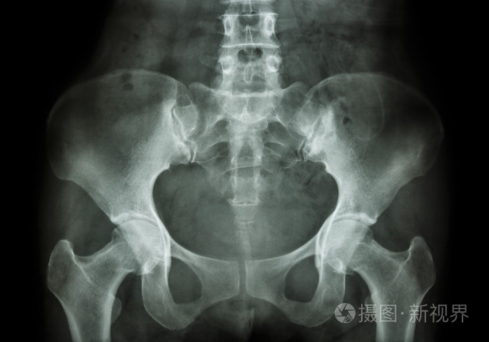 骨盆的 x 光胶片