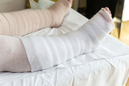 包扎病人的腿静脉曲张在腿上灰色的老女人纠正了弹性绷带绑她的腿的女