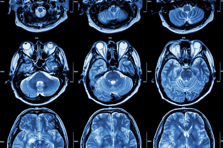 理疗师帮助老人举起手重量大脑正常ct扫描(计算机断层扫描)大脑的瘫痪