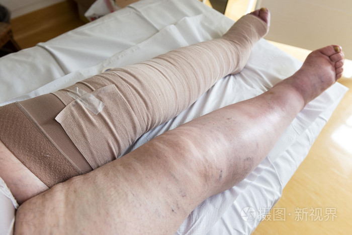 病人的腿缠着绷带