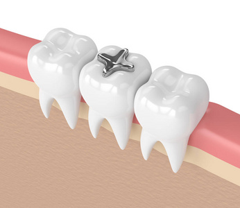 3d. 牙科汞合金填充牙的呈现