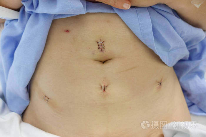 腹腔镜手术治疗瘤后妇女子宫肌瘤的病例照片 正版商用图片0fbn8s 摄图新视界 腹腔镜手术治疗瘤后妇女子宫肌瘤的病例照片 正版商用图片0fbn8s 摄图新视界