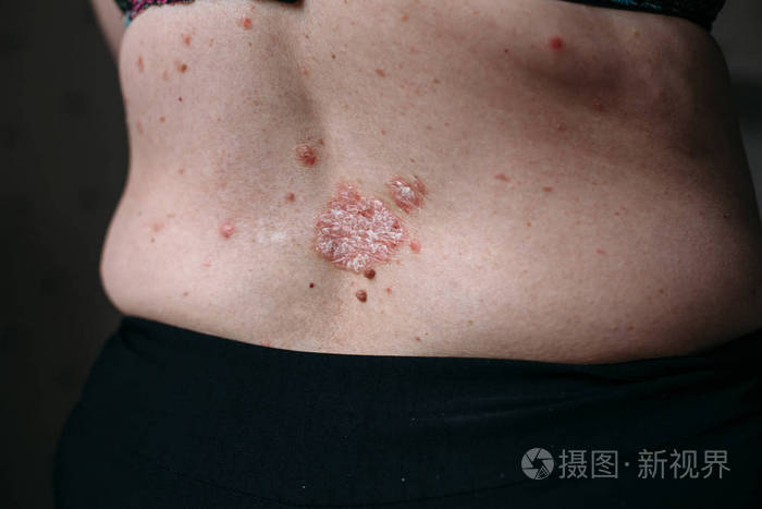 湿疹过敏性皮炎症状皮肤纹理 clouseup 照片