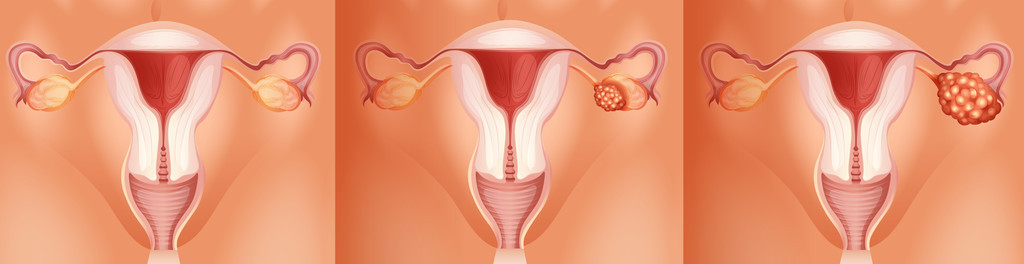 卵巢癌的三个阶段