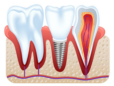 牙种植结构