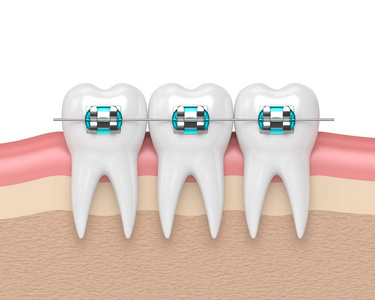 戴着牙套的牙齿的 3d 渲染