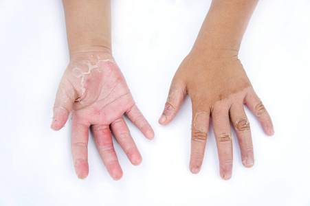 干手 剥离 接触性皮炎 真菌感染 皮肤感染从曝光