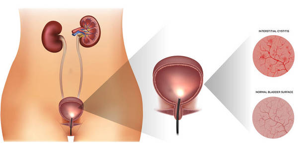 膀胱炎症与健康衬里图片