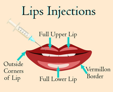 嘴唇注射载体例证