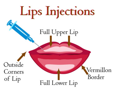 嘴唇注射载体例证