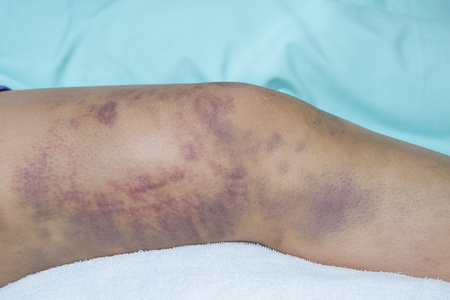 毛细血管破裂对受伤的女人的腿皮肤瘀特写照片