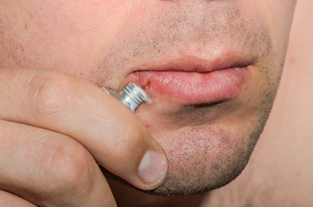 男性唇疱疹皮肤疾病创面软膏的治疗