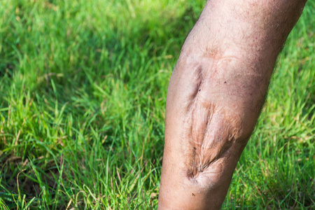 旧疤痕腿部受伤,从汽车或摩托车事故的旧伤疤照片