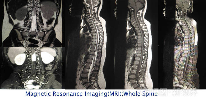关闭mri 全脊柱一个人显示多幅图像硬膜内外质量在 t11 水平的脊髓侧